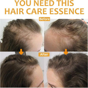 OUHOE - Biotin Hair Growth Serum